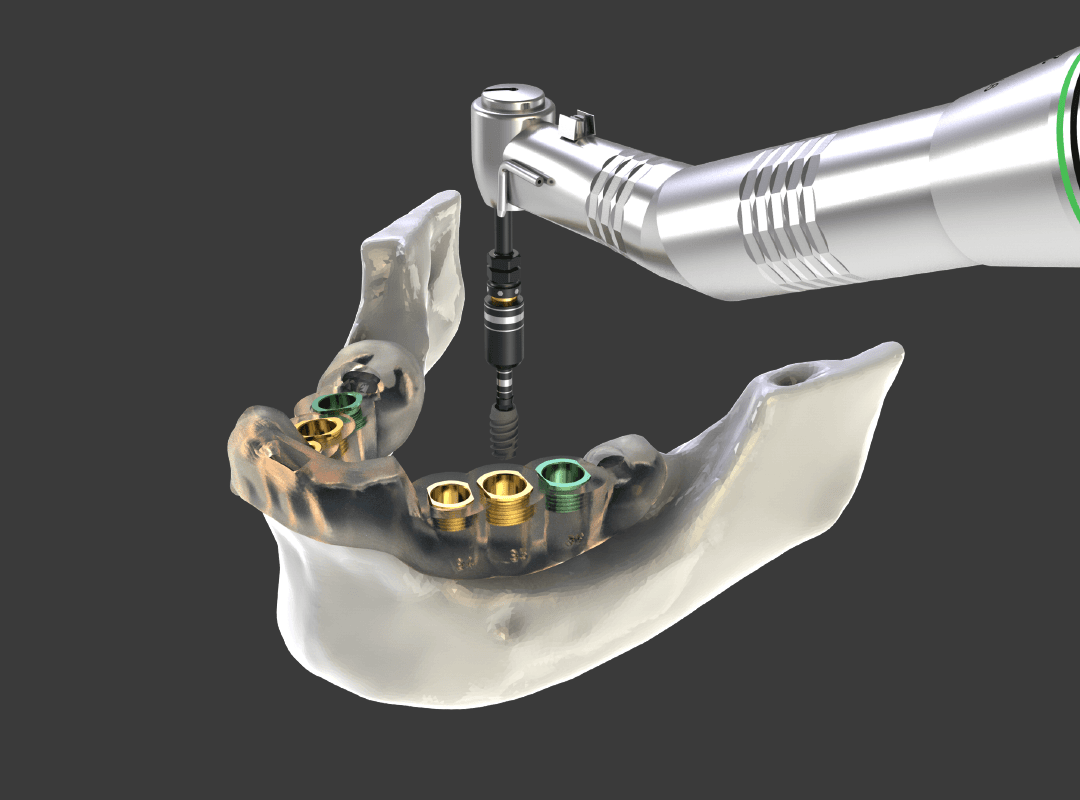 Jaw having screw-retained implants