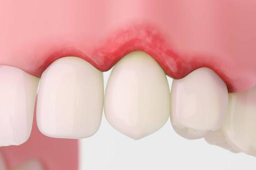 Recessão gengival ao redor de implantes dentários